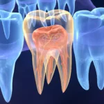 Терапия периодонтита зуба - Стоматология в Минске Easydentist | Лечение, протезирование зубов | Полечить зубы, вставить зубы Стоматология Easydentist