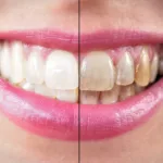 Зубной флюороз - Стоматология в Минске Easydentist | Лечение, протезирование зубов | Полечить зубы, вставить зубы Стоматология Easydentist