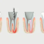 Эффективное пломбирование зубных каналов - Стоматология в Минске Easydentist | Лечение, протезирование зубов | Полечить зубы, вставить зубы Стоматология Easydentist