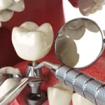 Протезирование зубов после удаления - Стоматология в Минске Easydentist | Лечение, протезирование зубов | Полечить зубы, вставить зубы Стоматология Easydentist