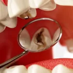 Кариес в глубоких стадиях: основные признаки, методы обнаружения и способы лечения. - Стоматология в Минске Easydentist | Лечение, протезирование зубов | Полечить зубы, вставить зубы Стоматология Easydentist