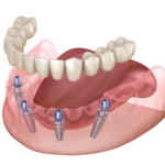 Имплантация зубов All-on-4: Полное руководство - Стоматология в Минске Easydentist | Лечение, протезирование зубов | Полечить зубы, вставить зубы Стоматология Easydentist