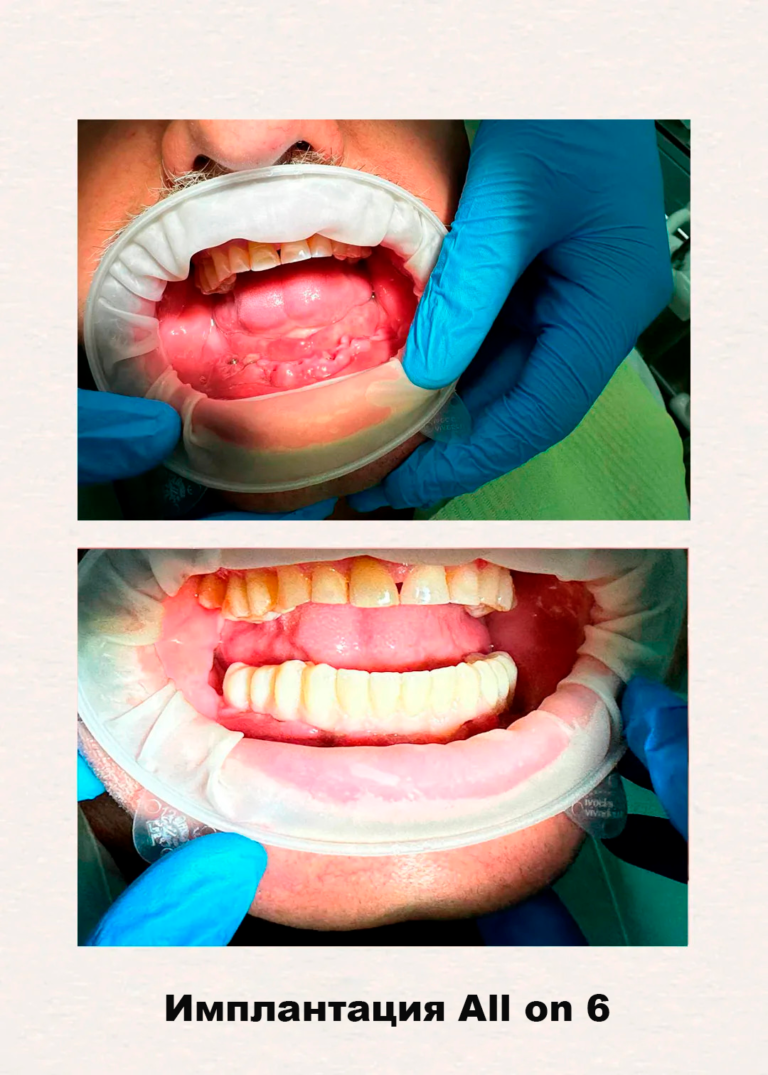 implantacia-jpg