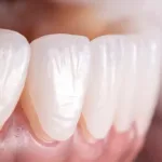 Виниры и люминиры: в чем отличия? - Стоматология в Минске Easydentist | Лечение, протезирование зубов | Полечить зубы, вставить зубы Стоматология Easydentist
