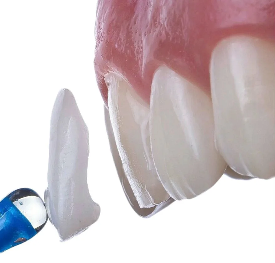 Виниры: виды, преимущества и недостатки - Стоматология в Минске Easydentist | Лечение, протезирование зубов | Полечить зубы, вставить зубы Стоматология Easydentist