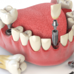 Несъемные протезы в ортопедической стоматологии - Стоматология в Минске Easydentist | Лечение, протезирование зубов | Полечить зубы, вставить зубы Стоматология Easydentist