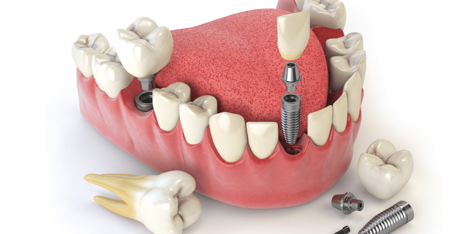 Несъемные протезы в ортопедической стоматологии - Стоматология в Минске Easydentist | Лечение, протезирование зубов | Полечить зубы, вставить зубы Стоматология Easydentist