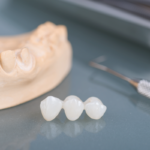 Отличия керамических коронок от виниров - Стоматология в Минске Easydentist | Лечение, протезирование зубов | Полечить зубы, вставить зубы Стоматология Easydentist