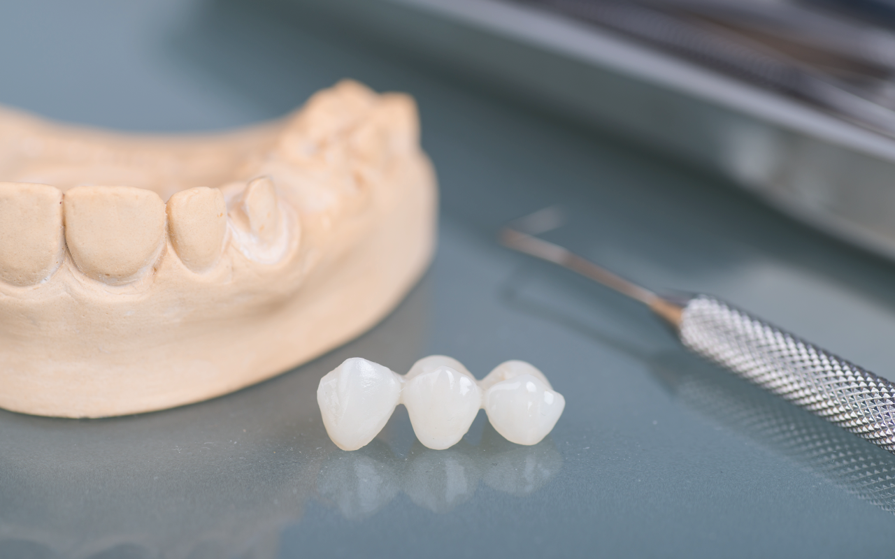 Отличия керамических коронок от виниров - Стоматология в Минске Easydentist | Лечение, протезирование зубов | Полечить зубы, вставить зубы Стоматология Easydentist