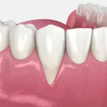 Гингивопластика в имплантации и хирургии - Стоматология в Минске Easydentist | Лечение, протезирование зубов | Полечить зубы, вставить зубы Стоматология Easydentist