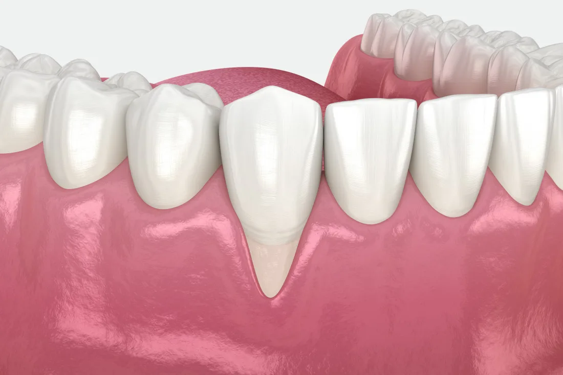 Гингивопластика в имплантации и хирургии - Стоматология в Минске Easydentist | Лечение, протезирование зубов | Полечить зубы, вставить зубы Стоматология Easydentist