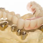 Виды фиксации коронок в стоматологии - Стоматология в Минске Easydentist | Лечение, протезирование зубов | Полечить зубы, вставить зубы Стоматология Easydentist