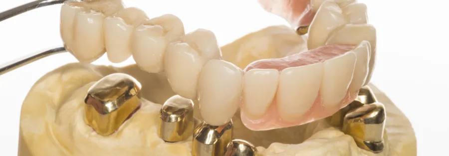 Виды фиксации коронок в стоматологии - Стоматология в Минске Easydentist | Лечение, протезирование зубов | Полечить зубы, вставить зубы Стоматология Easydentist