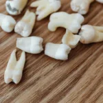 Удаление зубов ультразвуком - Стоматология в Минске Easydentist | Лечение, протезирование зубов | Полечить зубы, вставить зубы Стоматология Easydentist