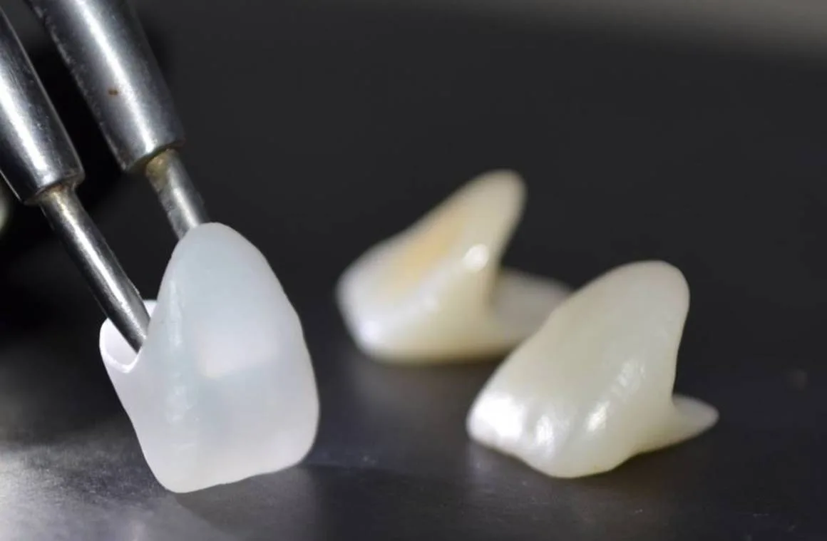 Что такое виниры методом прессования? - Стоматология в Минске Easydentist | Лечение, протезирование зубов | Полечить зубы, вставить зубы Стоматология Easydentist
