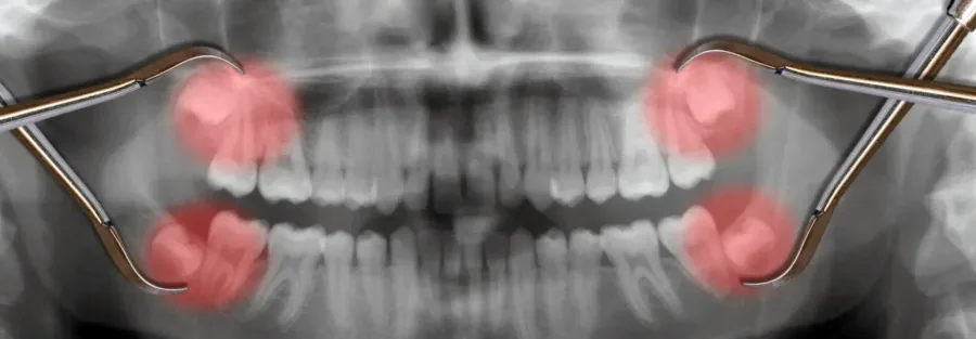 Удаление корня жевательного зуба: что нужно знать пациенту - Стоматология в Минске Easydentist | Лечение, протезирование зубов | Полечить зубы, вставить зубы Стоматология Easydentist
