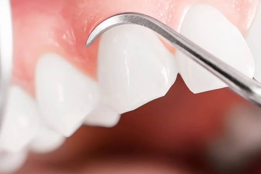 Кюретаж десен: что это и как проходит процедура - Стоматология в Минске Easydentist | Лечение, протезирование зубов | Полечить зубы, вставить зубы Стоматология Easydentist